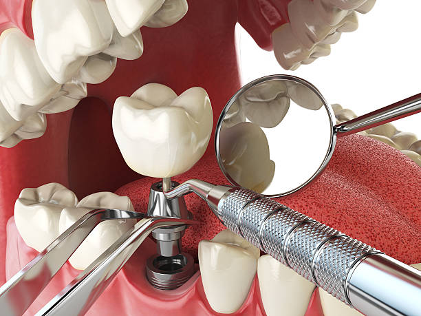 Best Broken or Chipped Tooth Repair in East Cleveland, TN